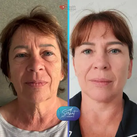 Derin Plan Yüz ve Boyun Germe