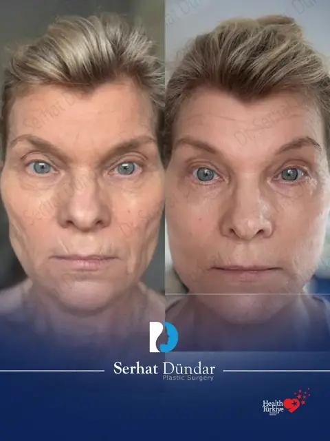 Derin Plan Yüz ve Boyun Germe + Göz Kapağı Estetiği
