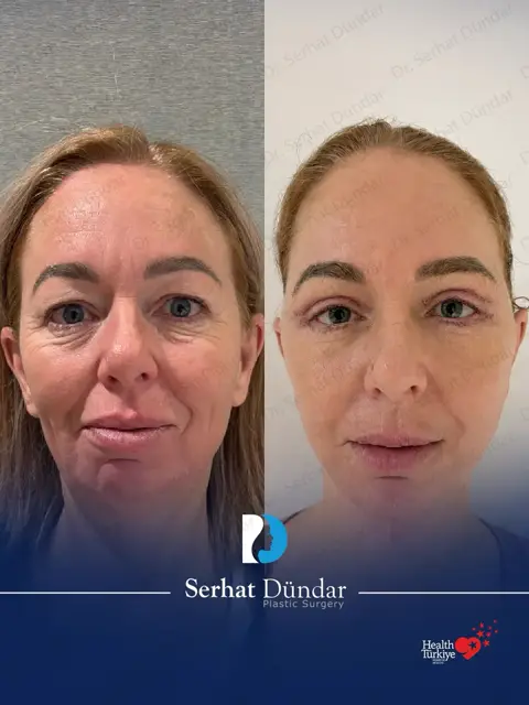 Derin Plan Yüz ve Boyun Germe + Göz Kapağı Estetiği