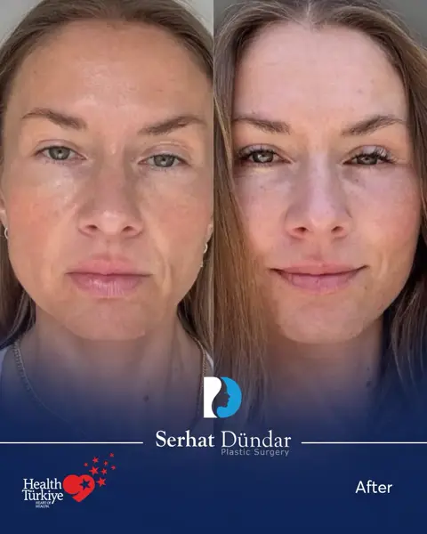 Derin Plan Yüz ve Boyun Germe + Göz Kapağı Estetiği · 1 yıl sonra