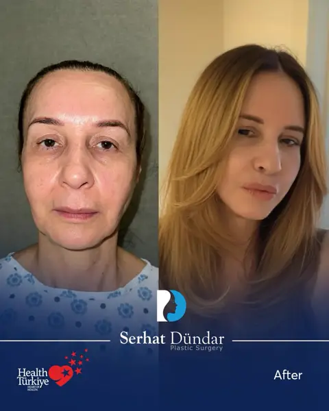 Derin Plan Yüz ve Boyun Germe + Göz Kapağı Estetiği · 3 ay sonra