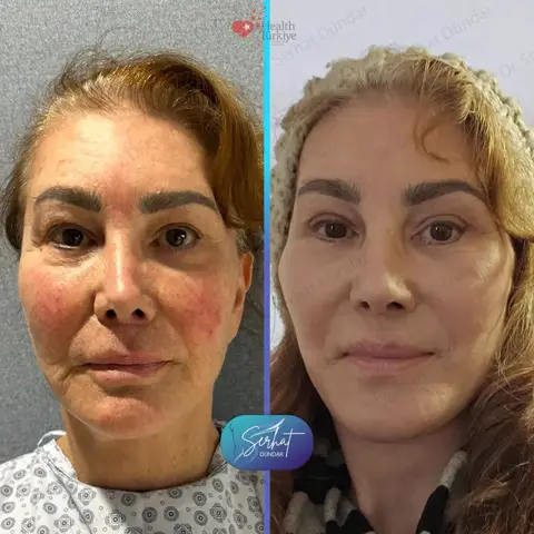 Derin Plan Yüz ve Boyun Germe + Yüze Yağ Enjeksiyonu