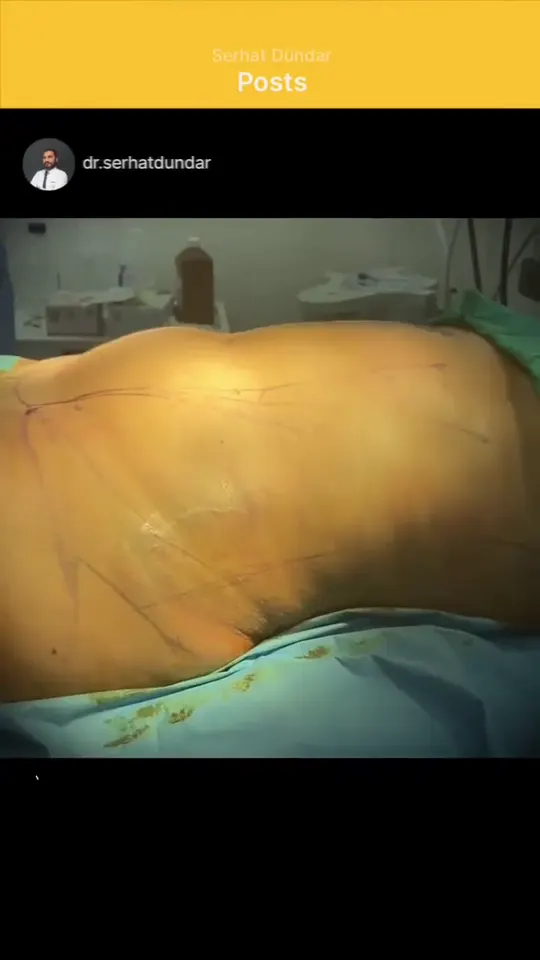 Liposuction