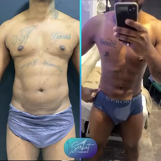 Liposuction